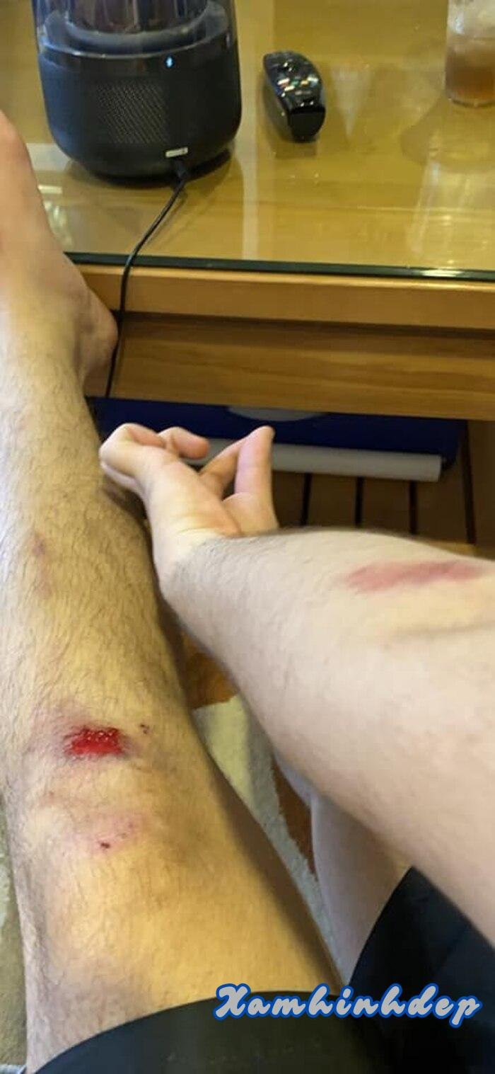 ảnh ngã xe đau full hd