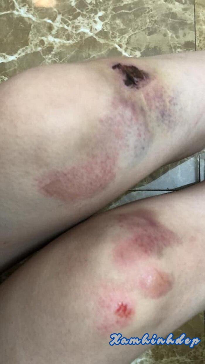 ảnh ngã xe đau hd