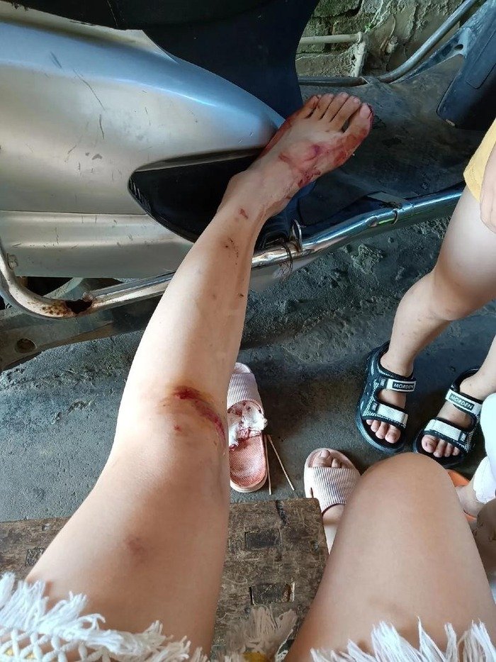 xử lý vết thương